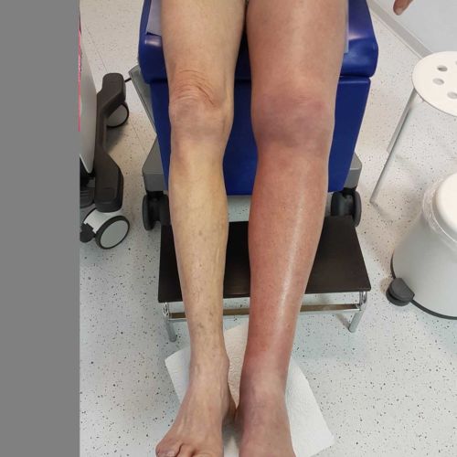 Thrombosenbehandlung als Praxisschwerpunkt Praxis Dr. med. Michael